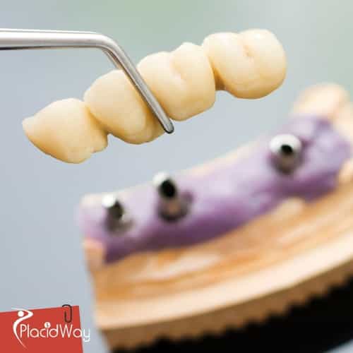 Bridges in Mexico: High-Quality Dental Care for California Patients at Lower Prices